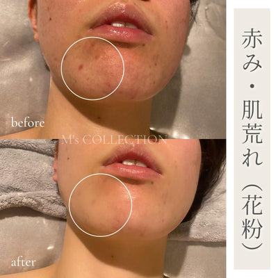 赤み・ニキビ・花粉による肌荒れでお悩みの方必見！