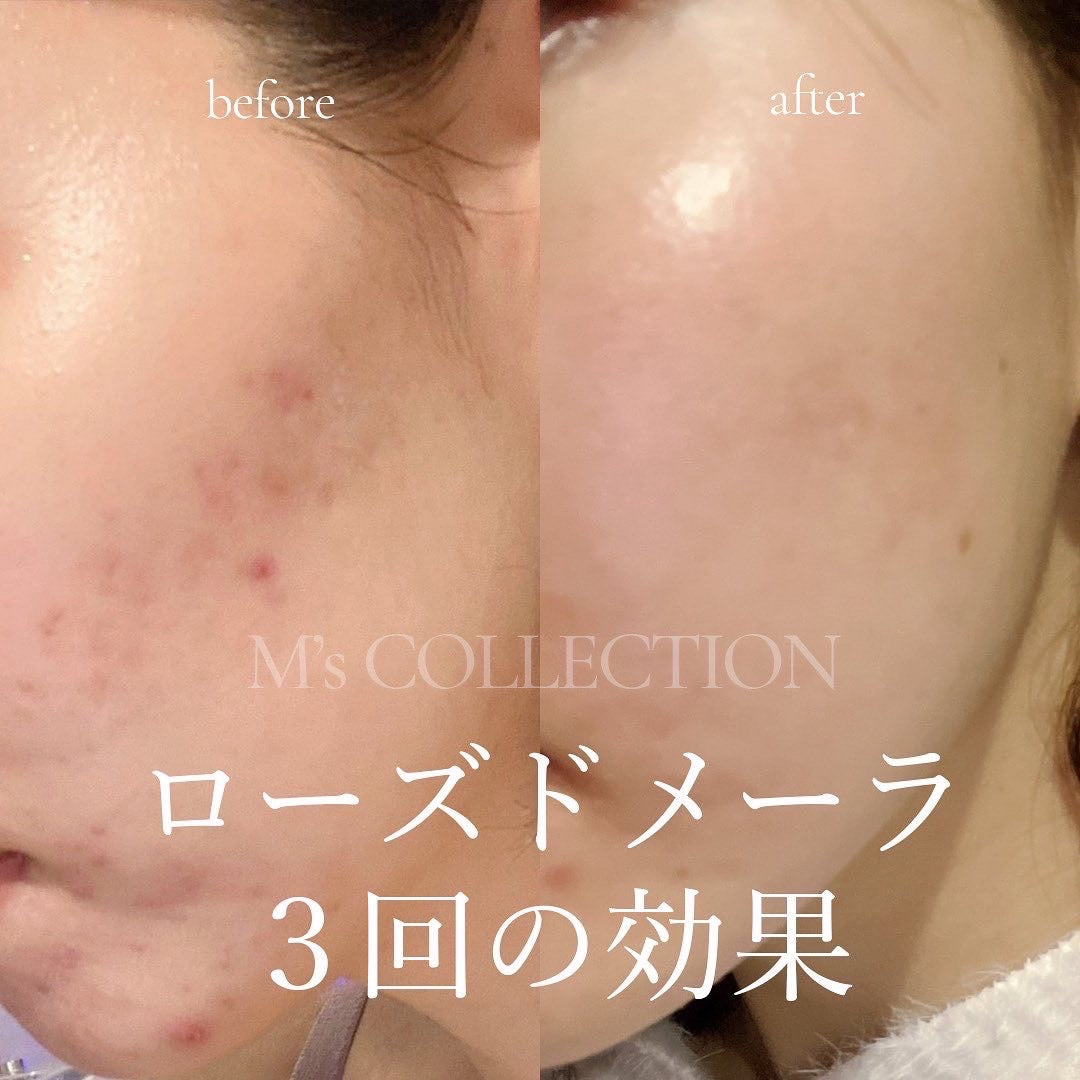 お客様からのお声🗣ローズドメーラ【Rose de Mer】3回の効果